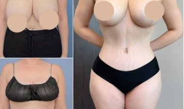 How Best Tummy Tuck Surgeons in dubai Create Natural Results