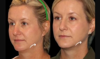Best Doctors in Dubai Offer Painless Sculptra Fillers Sessions