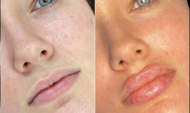 The Russian Lip Fillers Treatment in Dubai: A Step-by-Step Process Explained
