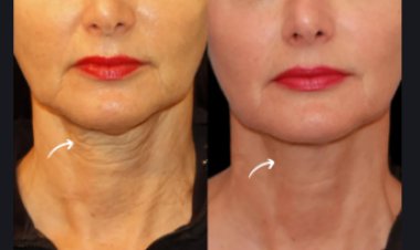 Sculptra Fillers Treatments in Dubai for the Décolletage and Neck Area