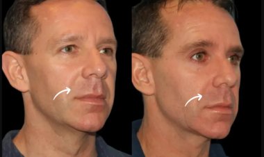 Celebrity-Approved: Best Aesthetic Clinics in Dubai Using Sculptra Fillers