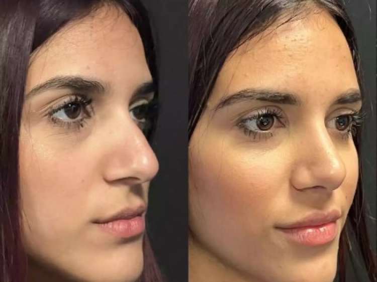 Top Technology Used by the Best Septoplasty Surgeons in Dubai
