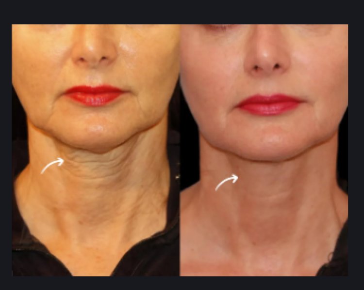 Sculptra Fillers Treatments in Dubai for the Décolletage and Neck Area