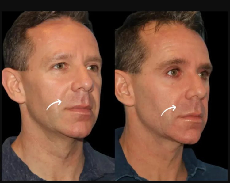 Celebrity-Approved: Best Aesthetic Clinics in Dubai Using Sculptra Fillers