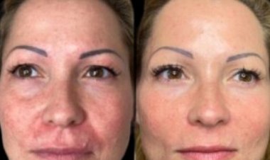 How Often Should You Get Profhilo: Guidance from the Best Plastic Surgeon in Dubai