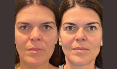 Neck Rejuvenation with Thread Lifts: Insights from the Best Doctors in Dubai