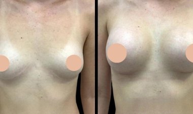 Breast Augmentation in Dubai: Different Techniques and Which One is Right for You