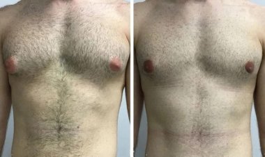 How to Choose the Best Gynecomastia Surgeons in Dubai for Your Needs