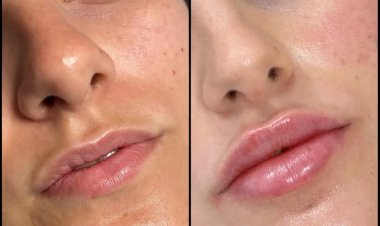 Why the Best Aesthetic Clinic in Dubai for Fillers is the Right Choice