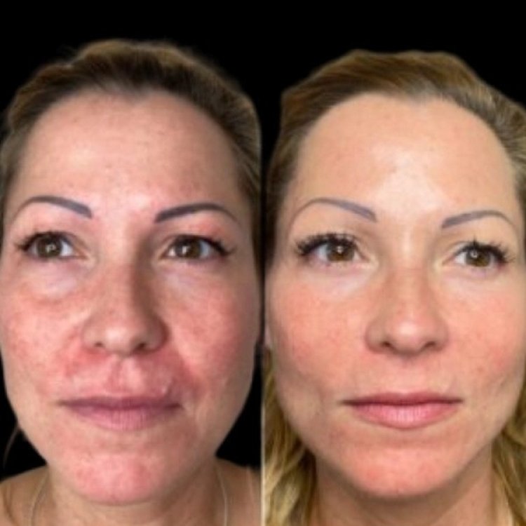 How Often Should You Get Profhilo: Guidance from the Best Plastic Surgeon in Dubai