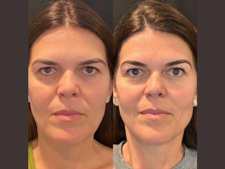 Neck Rejuvenation with Thread Lifts: Insights from the Best Doctors in Dubai