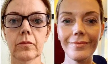 Start Fresh with Profhilo Treatment in Dubai