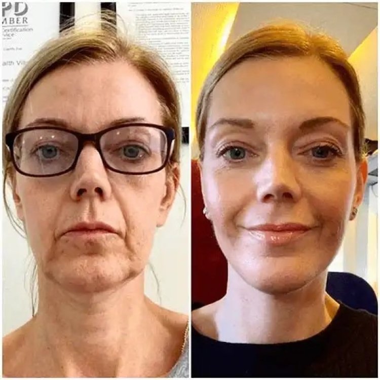 Start Fresh with Profhilo Treatment in Dubai