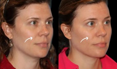 A Complete Beginner’s Guide to Sculptra Fillers Treatment in Dubai