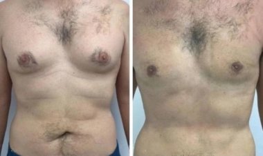 Long-Term Care After Gynecomastia Surgery in Dubai